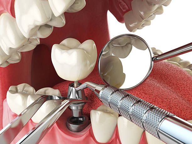 Best Emergency Dentist for Lost Fillings or Crowns in Braddock Hills, PA